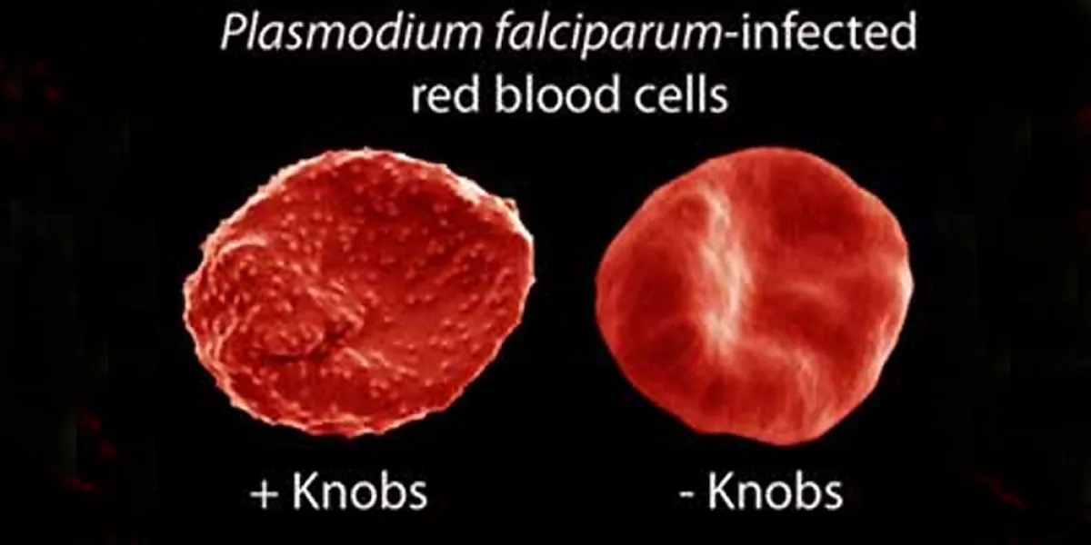 Microscopic image showing two Plasmodium falciparum-infected red blood cells, one with surface knobs and one without.